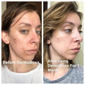 DermaBoss before after photo